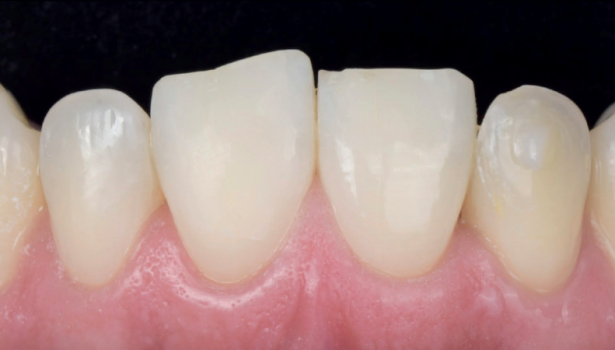 Fot. 1. Sytuacja wyjściowa. Widoczne skrócenie i nierówność brzegów siecznych zębów górnych