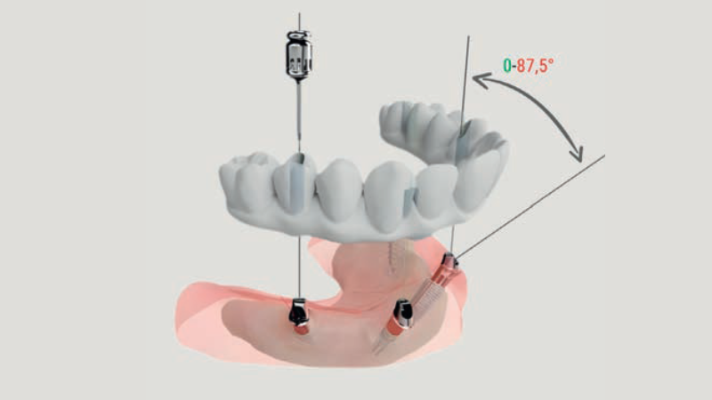 Rys. 1. Możliwości Multi-Unitu kątowego MULTIBIONIC