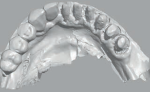 Fot. 1. Brak widoczności granicy preparacji, wynikającej z niezastosowania nici retrakcyjnej i nieodpowiedniego odsłonięcia tkanek miękkich