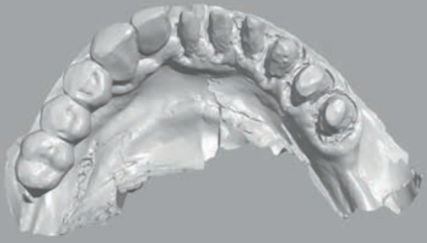 Fot. 1. Brak widoczności granicy preparacji, wynikającej z niezastosowania nici retrakcyjnej i nieodpowiedniego odsłonięcia tkanek miękkich