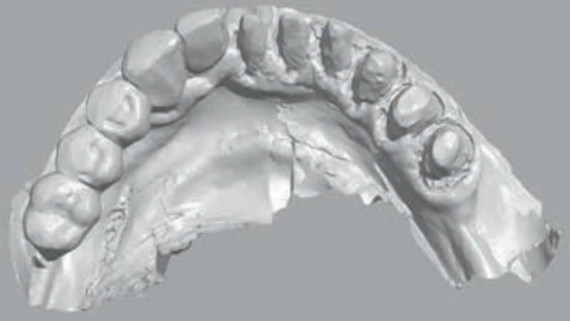 Fot. 1. Brak widoczności granicy preparacji, wynikającej z niezastosowania nici retrakcyjnej i nieodpowiedniego odsłonięcia tkanek miękkich