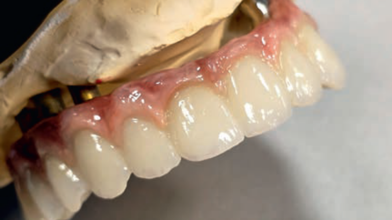 Fot. 4. Praca pełnokonturowa z kompozytowym dziąsłem