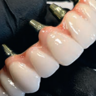 Naturalnie wyglądające dziąsło ceramiczne