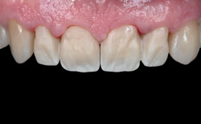 Fot. 4. Przymiarka podbudowy w jamie ustnej