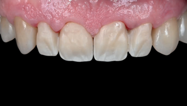 Fot. 4. Przymiarka podbudowy w jamie ustnej