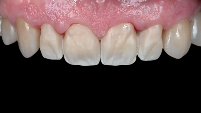 Fot. 4. Przymiarka podbudowy w jamie ustnej