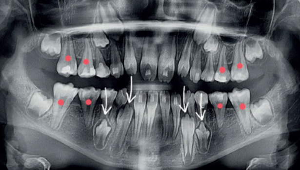 Zaburzenia morfologii koron i korzeni zębów
