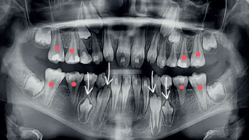 Zaburzenia morfologii koron i korzeni zębów