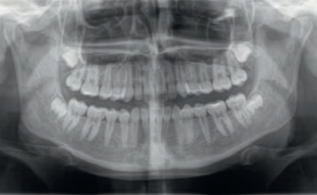 MARTWICZA SIALOMETAPLAZJA