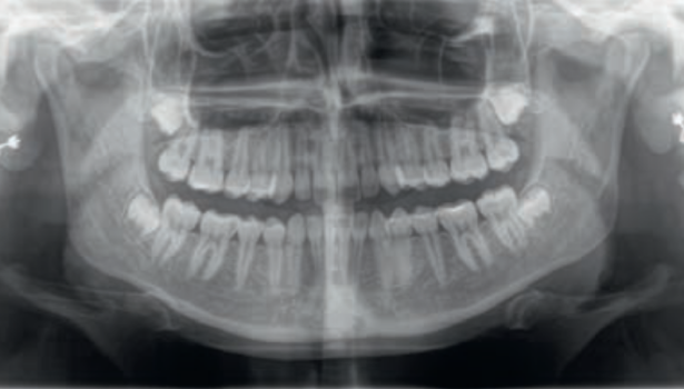 MARTWICZA SIALOMETAPLAZJA