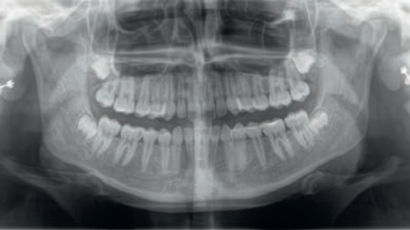 MARTWICZA SIALOMETAPLAZJA