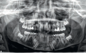 agenezja drugich zębów przedtrzonowych