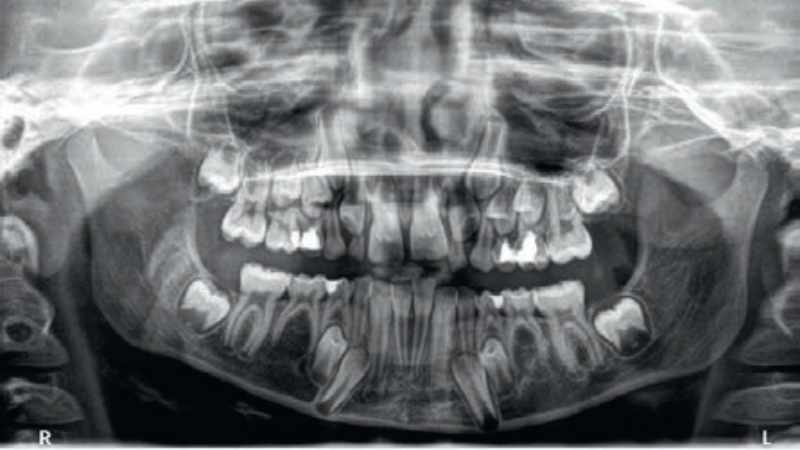 agenezja drugich zębów przedtrzonowych